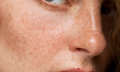 Clarificando-Manchas-de-Pele-Identificando-Melasma-00-21-06-24 (2)